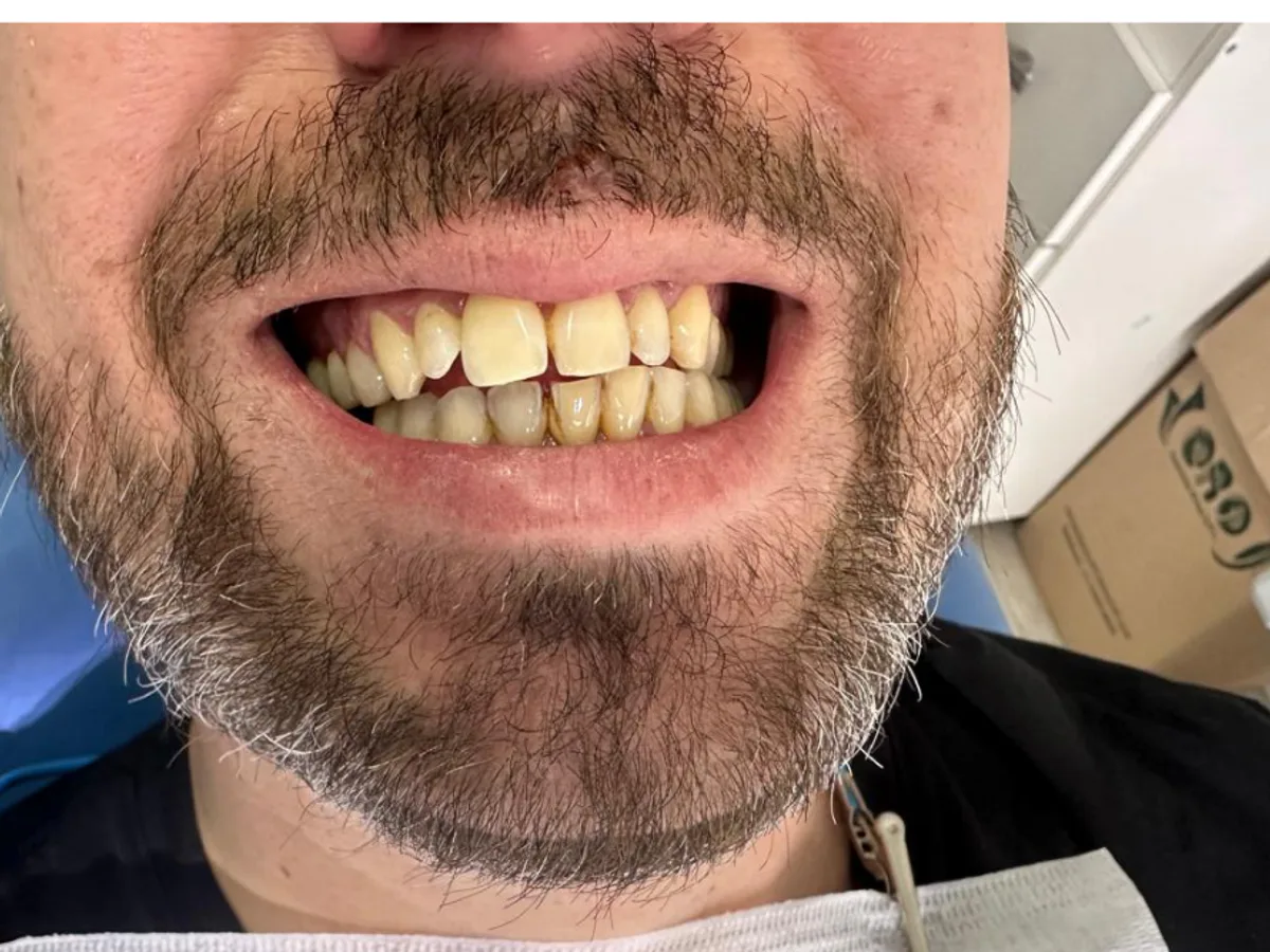 Sonrisa antes del tratamiento con 24 carillas sin desgaste