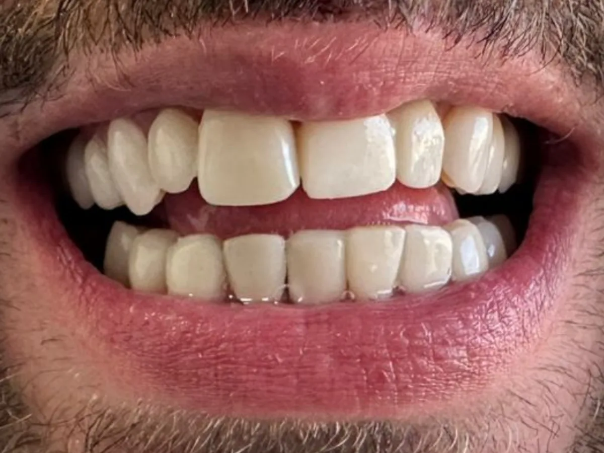 Resultado final natural de 24 carillas sin desgaste